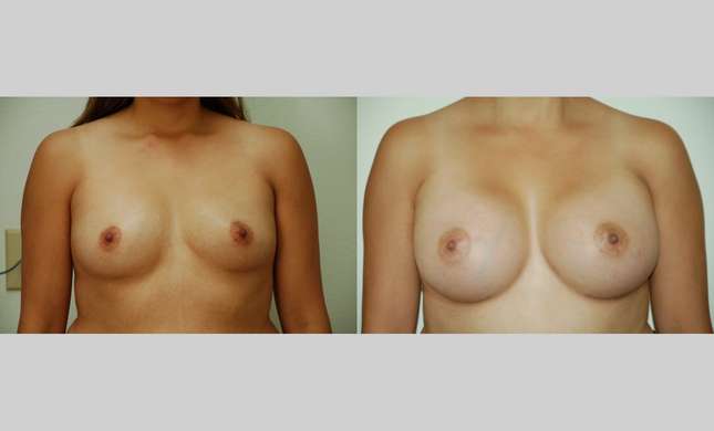 Breast Augmentation: Image #340