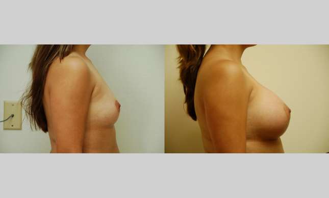 Breast Augmentation: Image #341