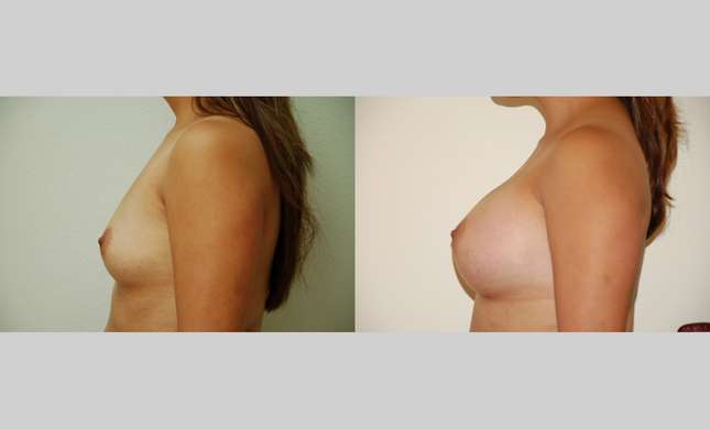 Breast Augmentation: Image #342