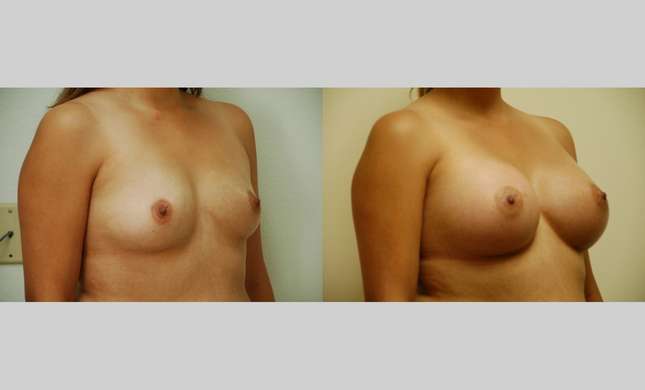 Breast Augmentation: Image #343