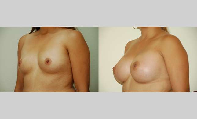 Breast Augmentation: Image #344