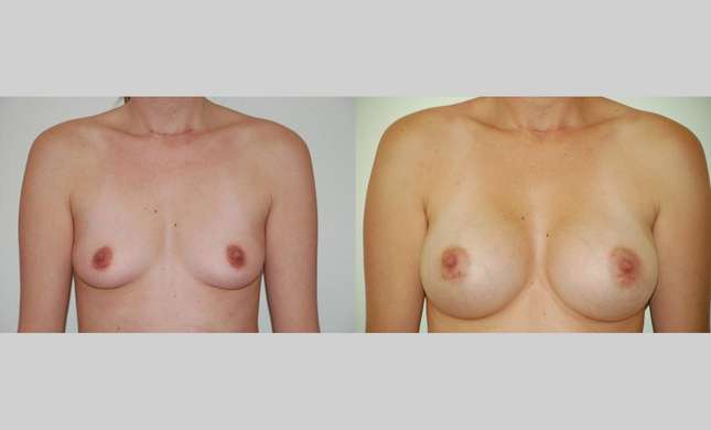 Breast Augmentation: Image #345