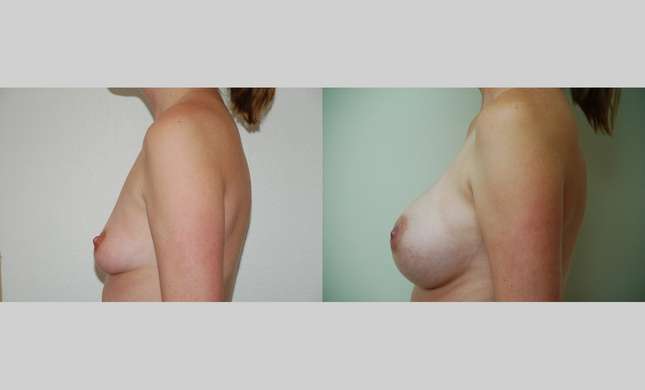 Breast Augmentation: Image #346