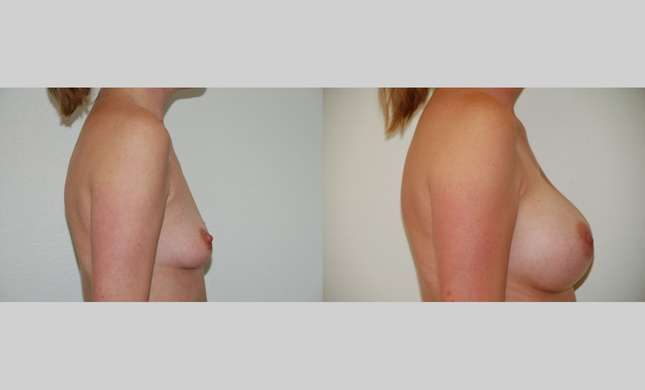 Breast Augmentation: Image #347