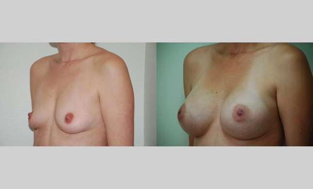 Breast Augmentation: Image #348