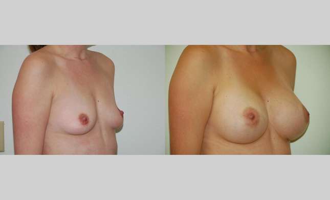 Breast Augmentation: Image #349