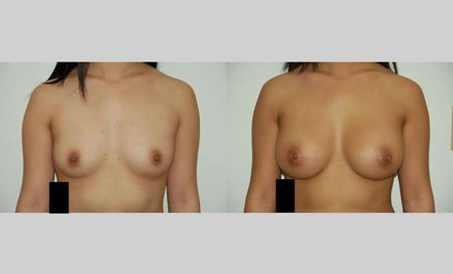 Breast Augmentation: Image #35