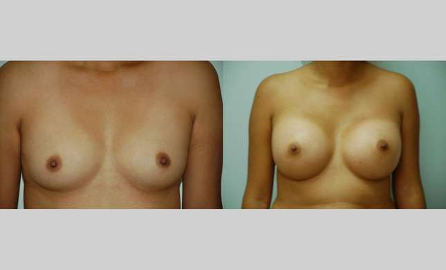 Breast Augmentation: Image #350