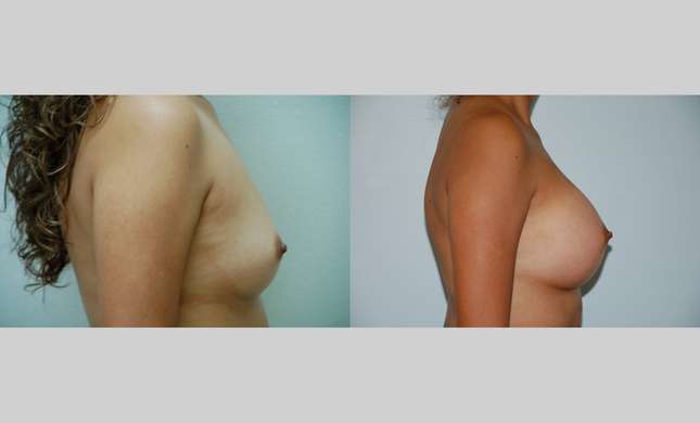 Breast Augmentation: Image #351