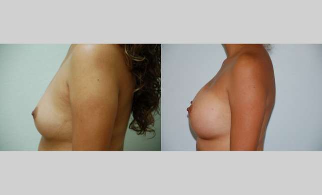 Breast Augmentation: Image #352