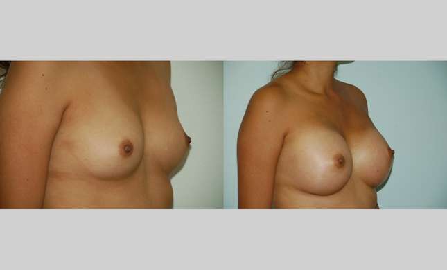 Breast Augmentation: Image #353