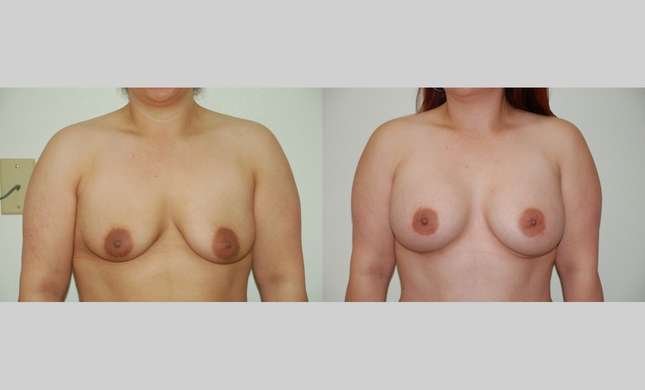 Breast Augmentation: Image #355