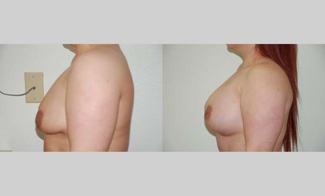Breast Augmentation: Image #356