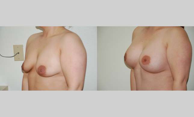 Breast Augmentation: Image #357