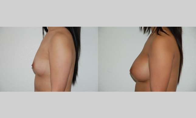 Breast Augmentation: Image #36