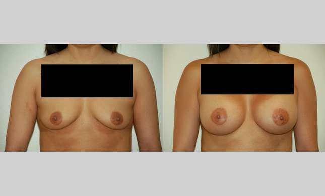 Breast Augmentation: Image #360
