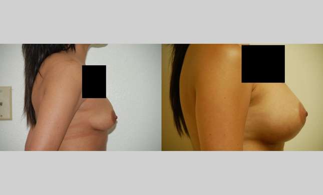 Breast Augmentation: Image #361