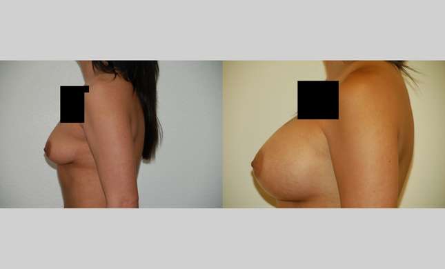 Breast Augmentation: Image #362
