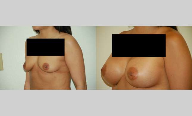 Breast Augmentation: Image #363
