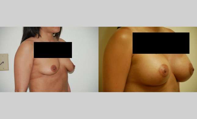 Breast Augmentation: Image #364