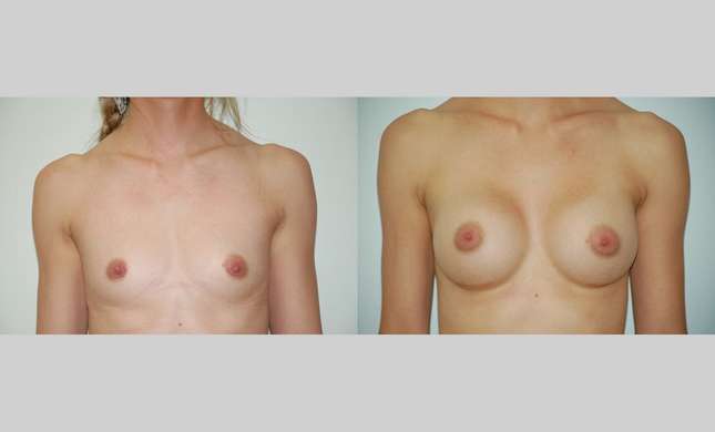 Breast Augmentation: Image #365