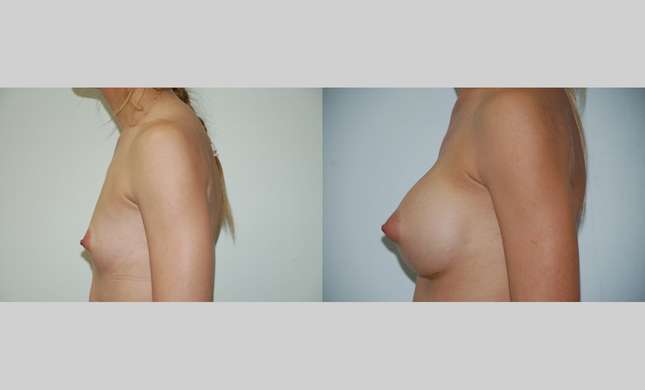 Breast Augmentation: Image #366