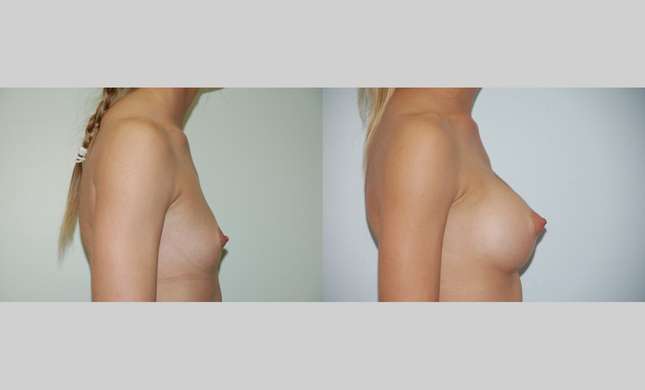 Breast Augmentation: Image #367