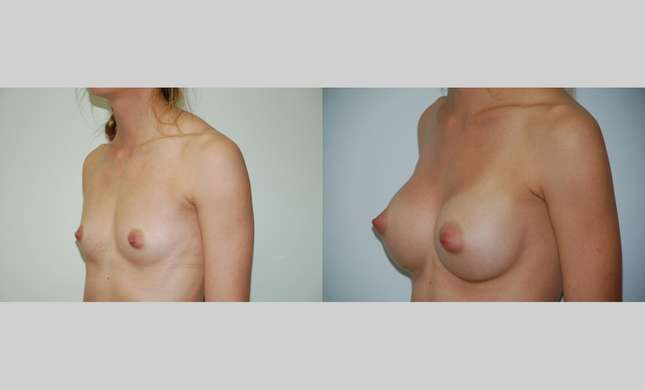 Breast Augmentation: Image #368