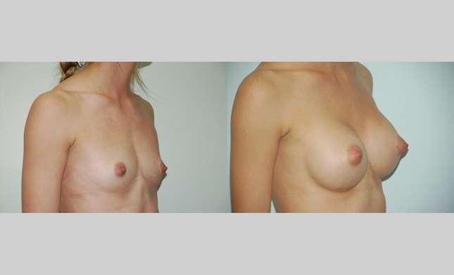 Breast Augmentation: Image #369