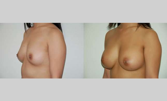Breast Augmentation: Image #37
