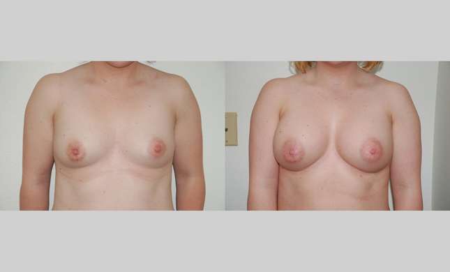 Breast Augmentation: Image #370