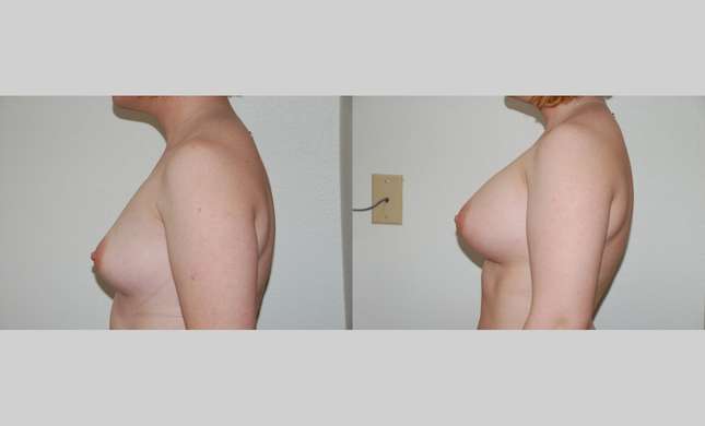Breast Augmentation: Image #371