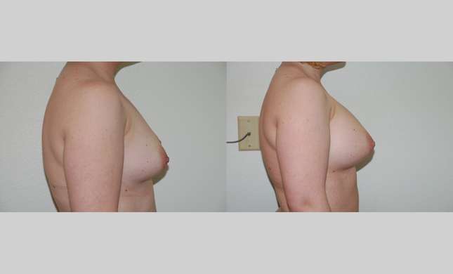 Breast Augmentation: Image #372