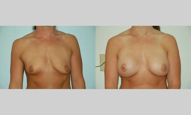 Breast Augmentation: Image #373