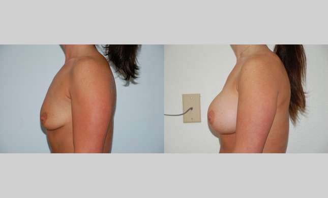 Breast Augmentation: Image #374