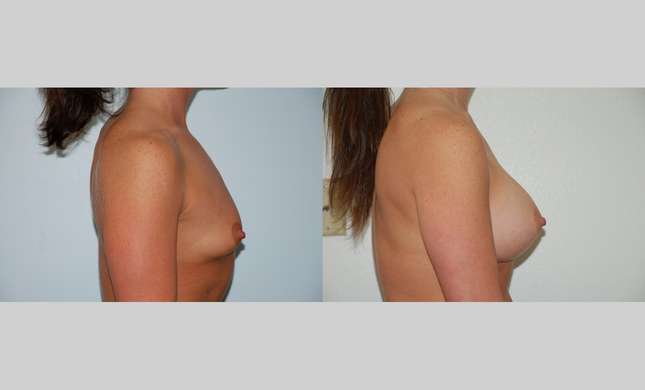 Breast Augmentation: Image #375