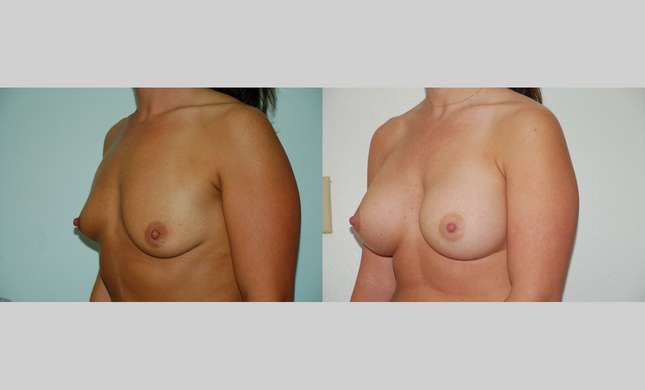 Breast Augmentation: Image #376