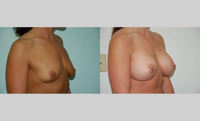 Breast Augmentation: Image #377