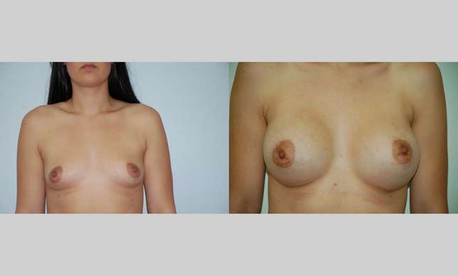 Breast Augmentation: Image #378