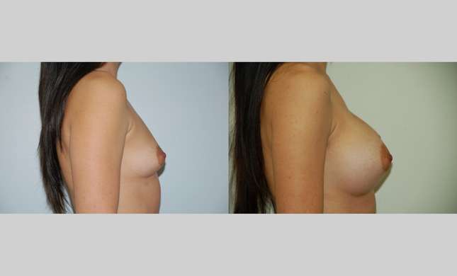 Breast Augmentation: Image #379
