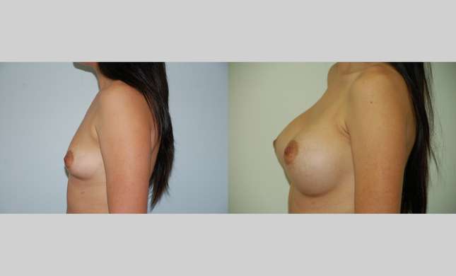 Breast Augmentation: Image #380