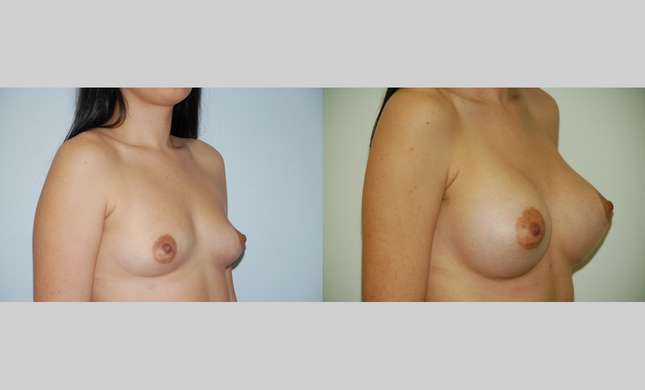 Breast Augmentation: Image #381