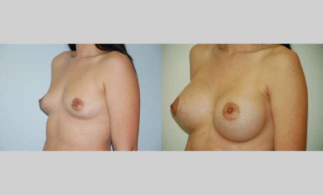 Breast Augmentation: Image #382