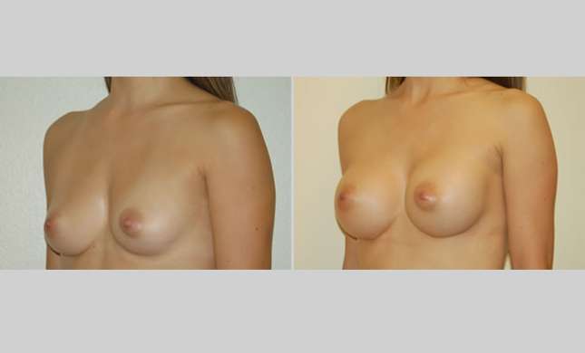 Breast Augmentation: Image #4