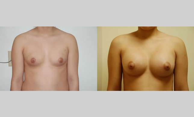Breast Augmentation: Image #41