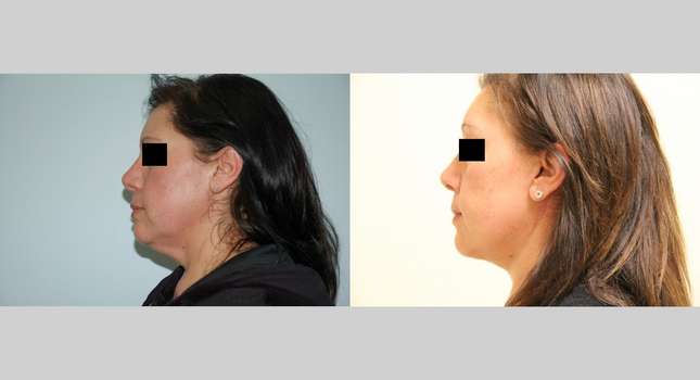 Facial Rejuvenation: Image #411