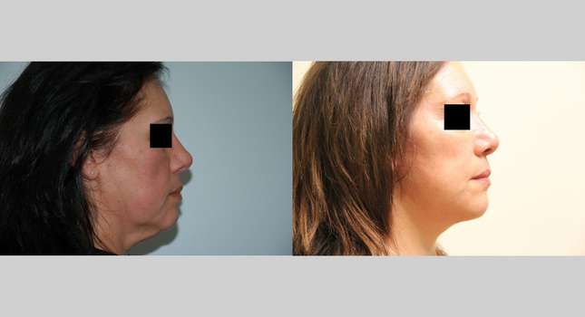 Facial Rejuvenation: Image #412