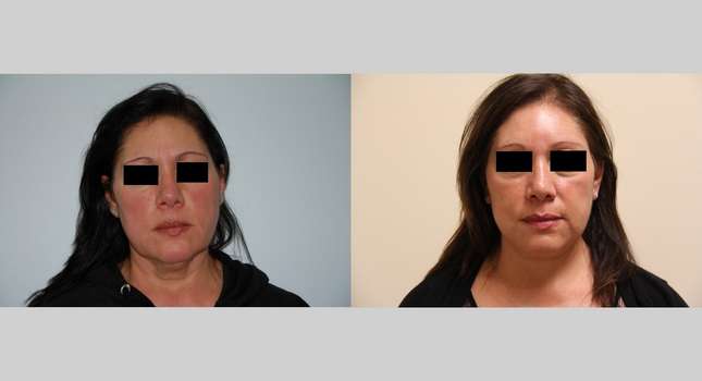 Neck Lift: Image #414
