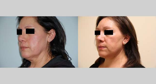 Neck Lift: Image #417