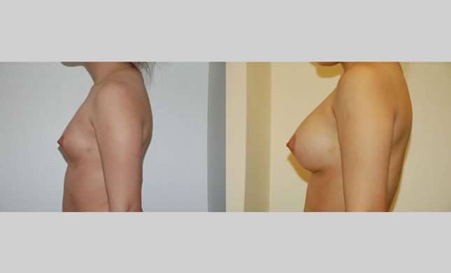 Breast Augmentation: Image #42